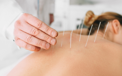 Acupuncture